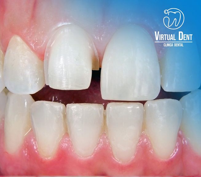 Dientes frontales antes del tratamiento