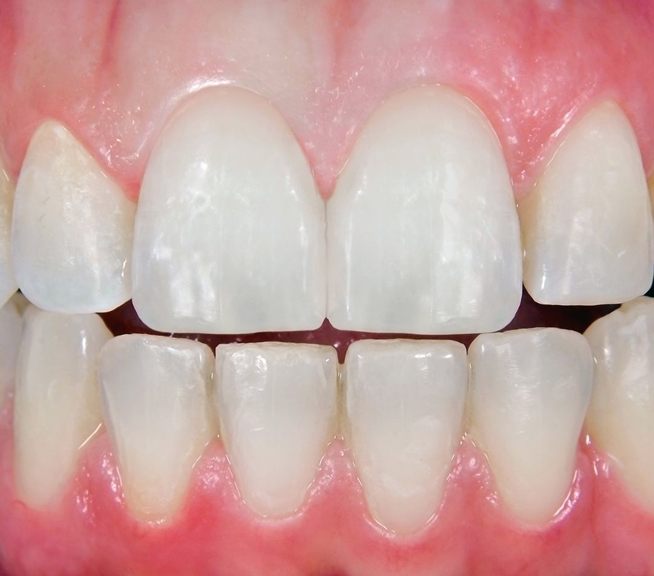 Dientes frontales después de una restauración estética